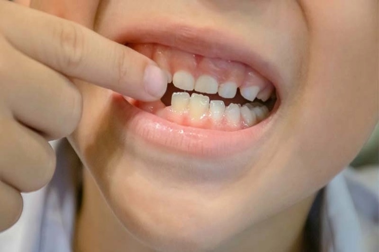 10 Yaşındaki Çocuğun Dişi Kırılırsa Yeni Diş Çıkar Mi?