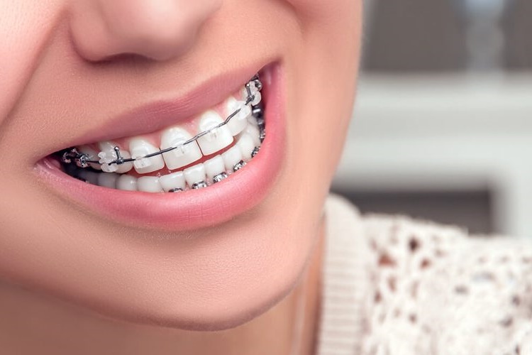 32 Yaşında Diş Teli Takılır Mı?