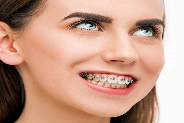 45 Yaşında Diş Teli Takılır Mı?