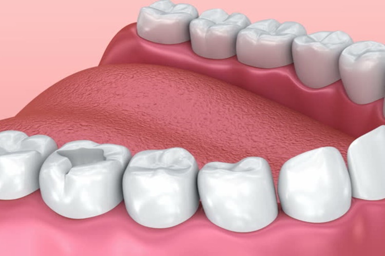 6 Yaşındaki Çocuğa Diş Dolgusu Yapılır Mı?