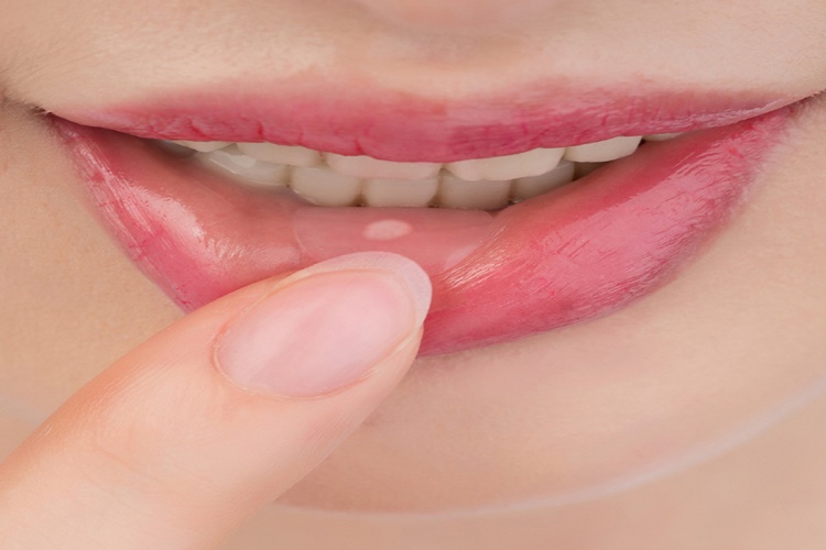 Ağız İçi Yaraları Hangi Vitamin Eksikliğinden Olur?