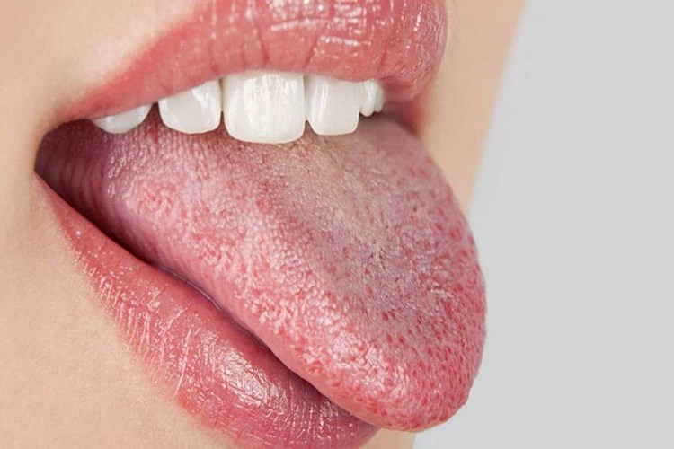 Ağızda Aft Hangi Vitamin Fazlalığı Sebebiyle Olur?