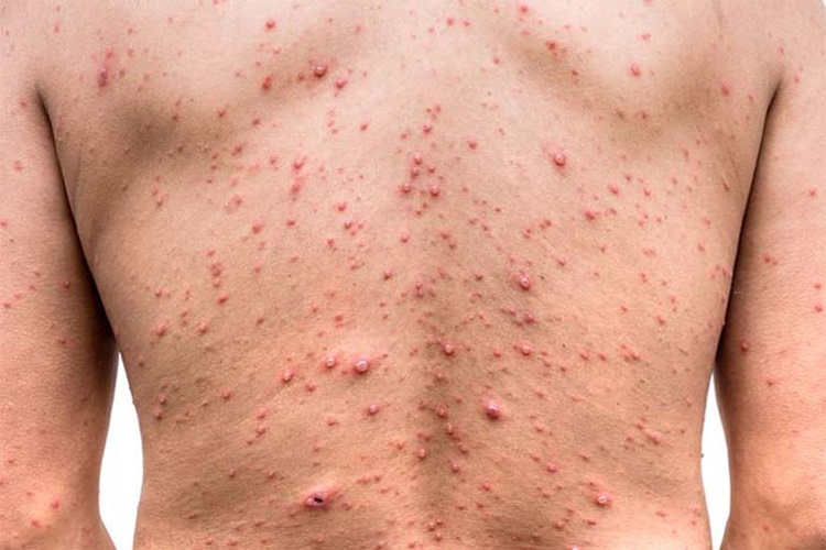 AIDS Belirtileri Nelerdir?