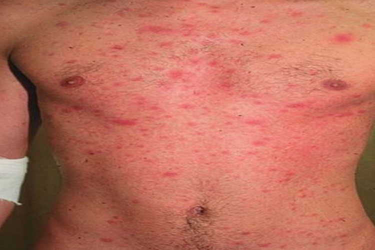AIDS Belirtileri Kaç Ayda Ortaya Çıkar?