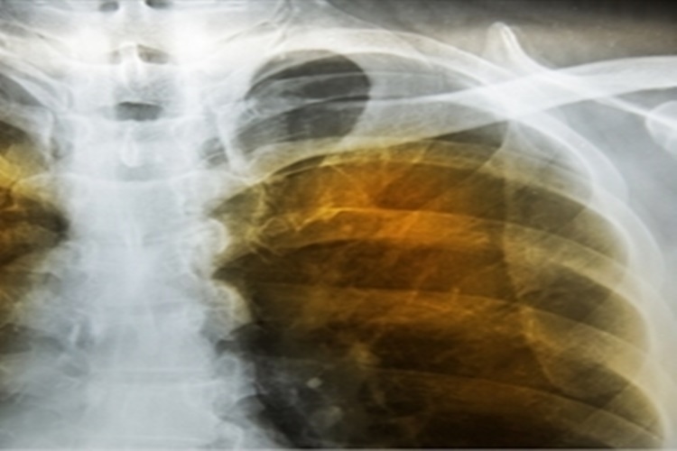 Akciğer Amfizemi Nedir?
