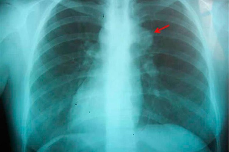 Akciğer Sönmesi Bulaşıcı Mı?