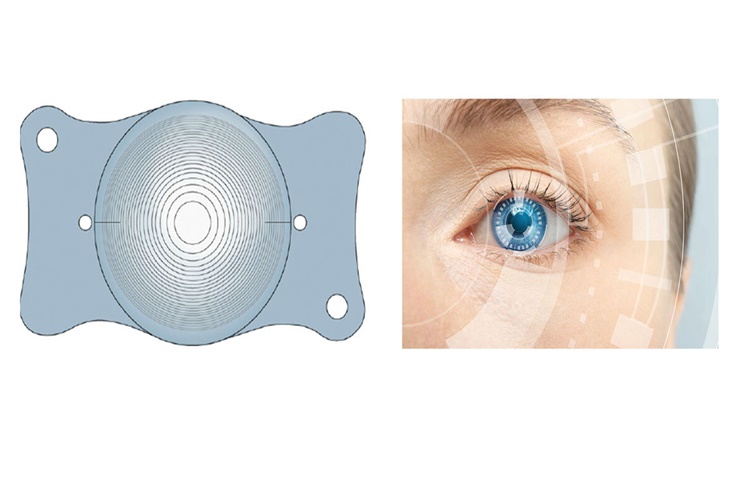 Akıllı Lens Başarı Oranı Nedir?