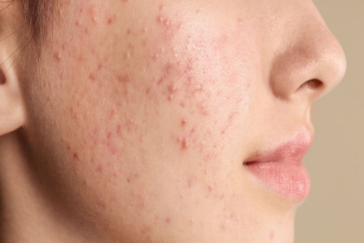 Aknetrent Polisliğe Engel Mi?