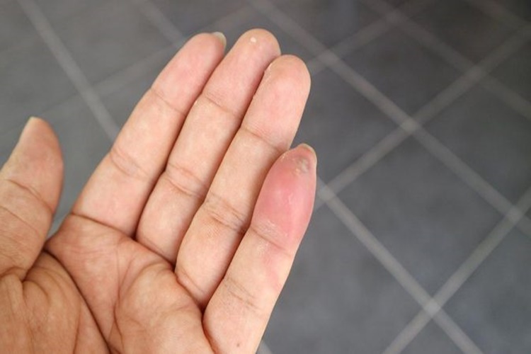 Akrep Sokması Bitkisel Tedavi Nedir?