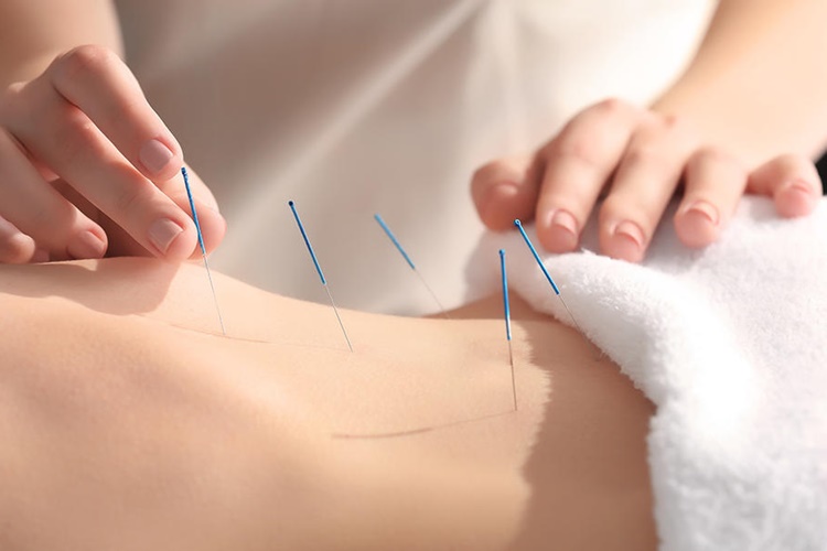 Akupunktur İle Kilo Vermek Mümkün Mü?