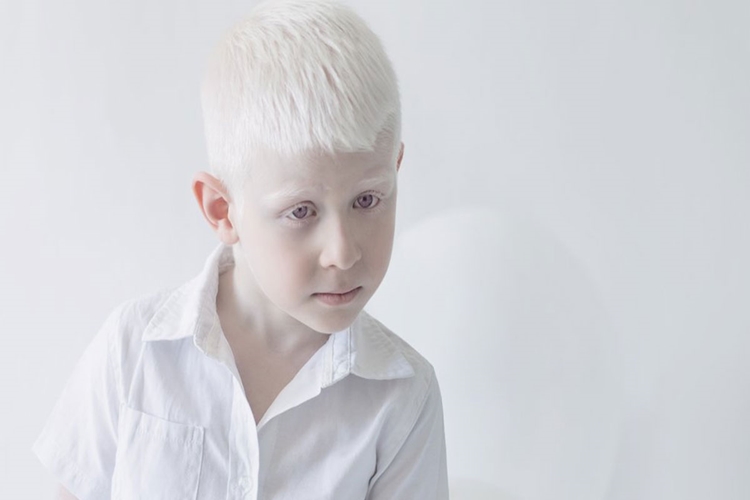 Albino Sonradan Olur Mu?