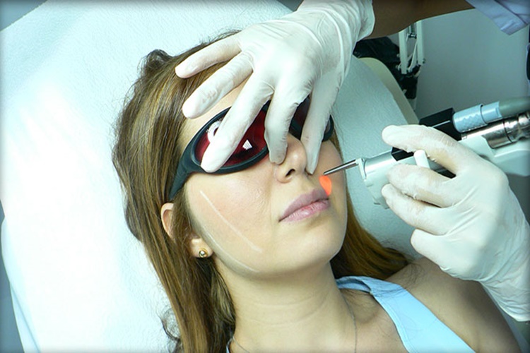 Alexandrite Lazer ve Buz Lazer Farkları Nelerdir?