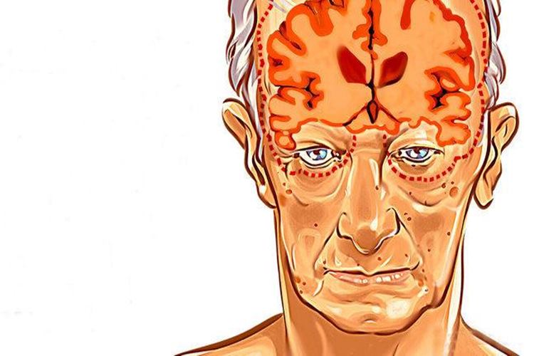 Alzheimer Belirtileri Nedir? - Güncel Oku