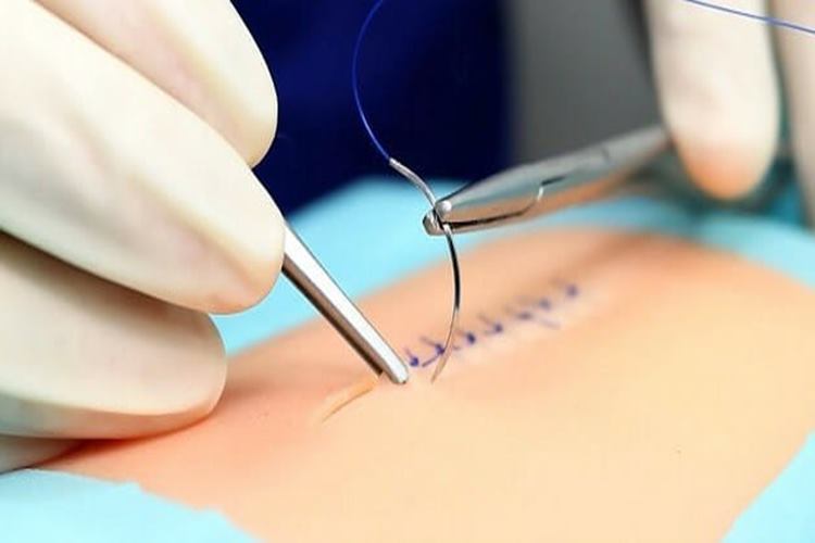 Ameliyat Dikişleri Kaç Günde Düşer?
