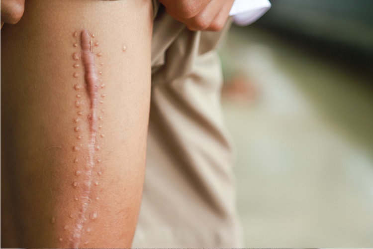 Ameliyat Dikişleri Ne Zaman Erir? Güncel Oku