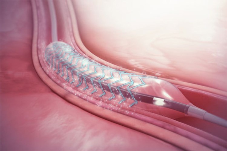 Anjiyoda Stent Takıldıktan Sonra Ağır Yük Kaldırılır Mı?