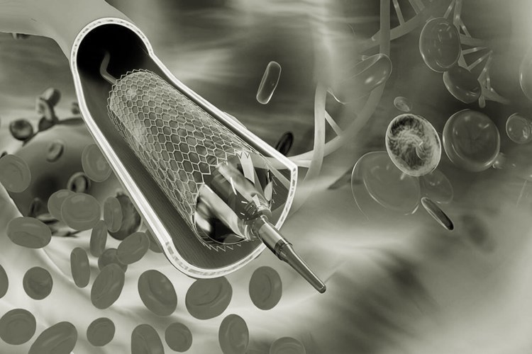 Anjiyoda Stent Takıldıktan Sonra Çarpıntı Nasıl Geçer?
