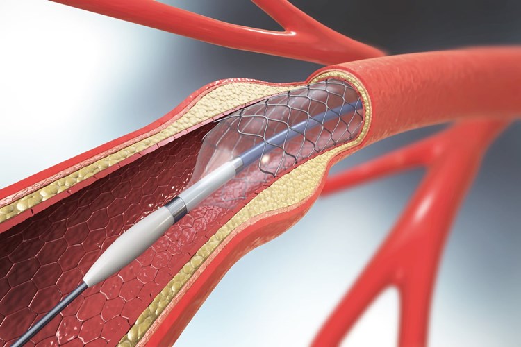 Anjiyoda Stent Takıldıktan Sonra Çarpıntı Neden Olur?
