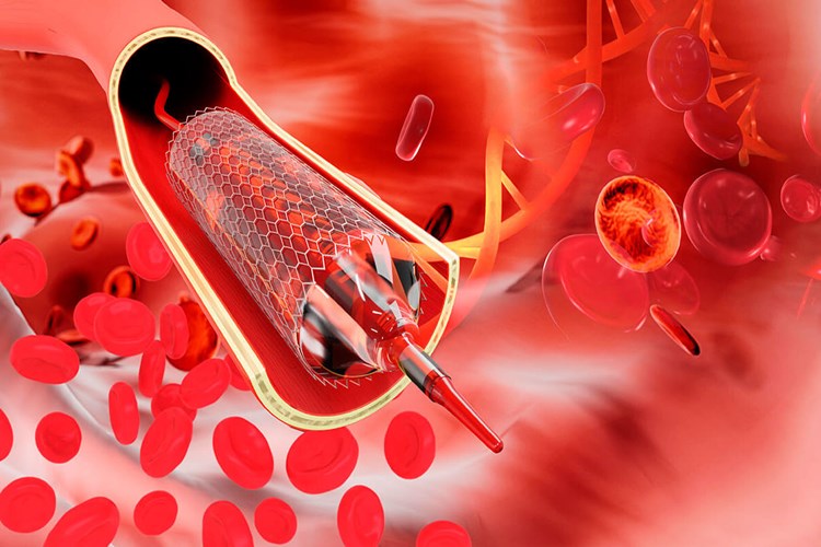 Anjiyoda Stent Takıldıktan Sonra Taburcu Ne Zaman Olunur?