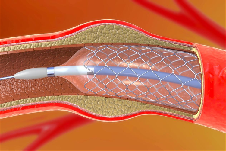 Anjiyoda Stent Takıldıktan Sonra Tansiyon Düşüklüğü Nasıl Geçer?