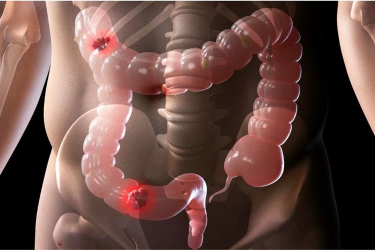 Antibiyotik Bağırsakta Kanama Yapar Mı?