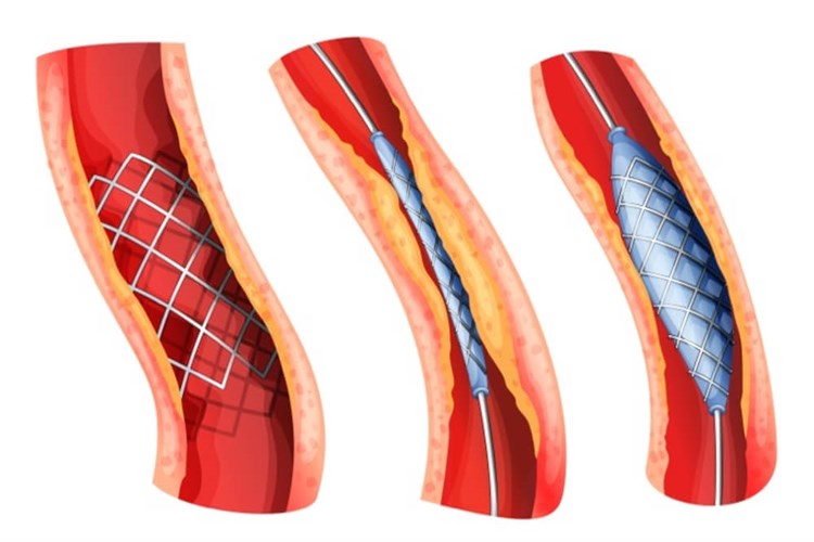 Aort Damarına Stent Takıldıktan Sonra Çarpıntı Olur Mu?