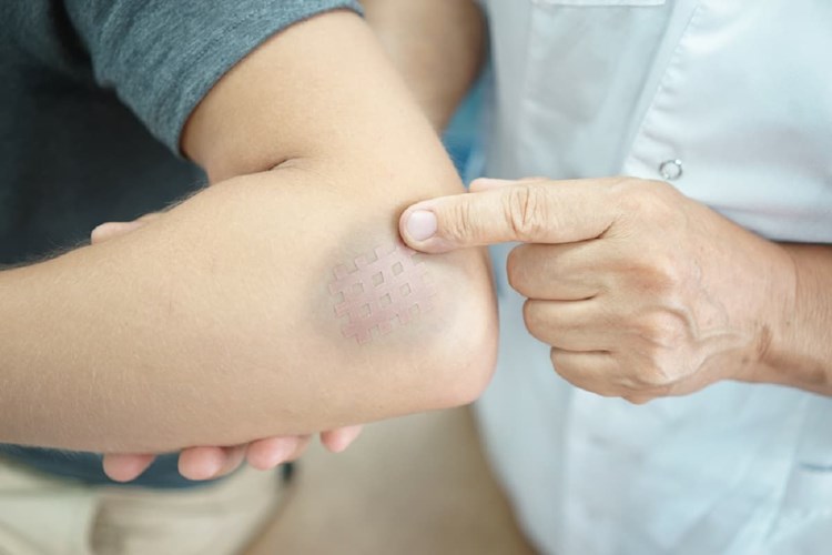 Aort Damarına Stent Takıldıktan Sonra Morarma Nasıl Geçer?