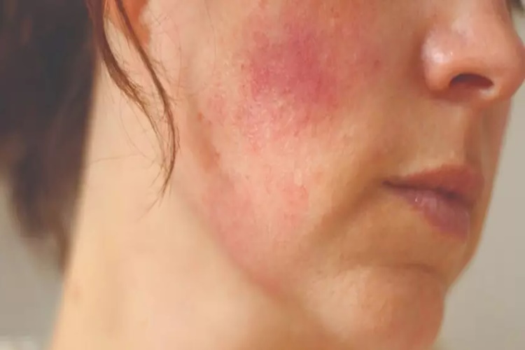 Arnica Krem Güneş Yanığa İyi Gelir Mi?