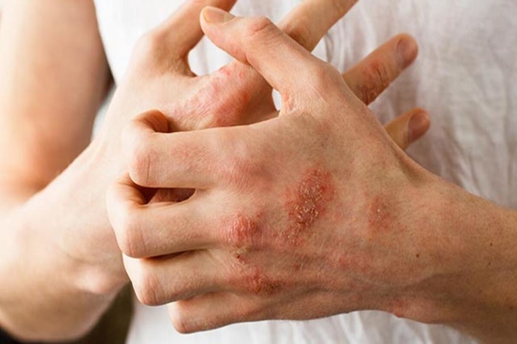 Atopik Dermatit Geçer Mi?