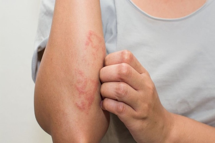 Atopik Dermatit İlaçları Nelerdir?