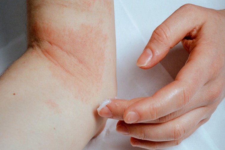 Atopik Dermatit Lekeleri Nasıl Geçer?