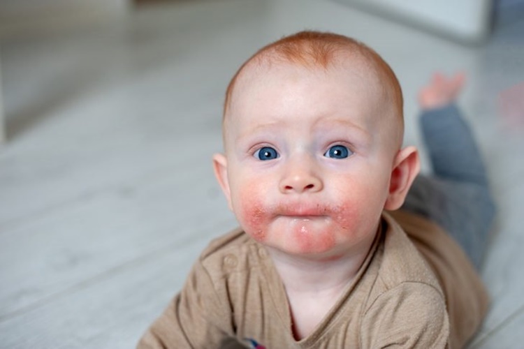 Atopik Dermatit Nasıl Geçer? 