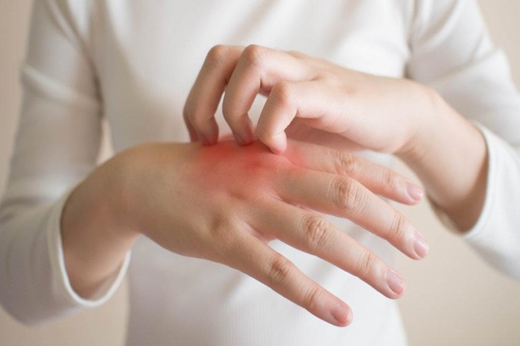 Atopik Dermatit Ne Yememelidir?