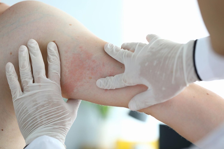 Augmentin Alerji Yapar Mı?