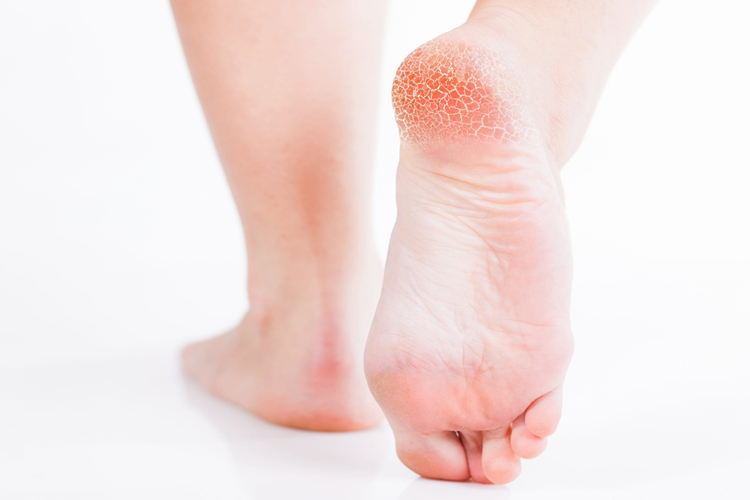 Ayak Topuğuna Vazelin Sürülür Mü?