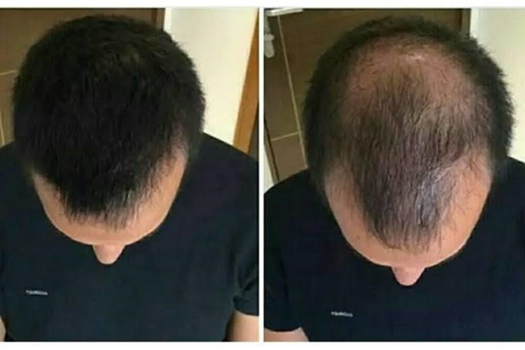 B12 Vitamini Saç Çıkarır Mı?