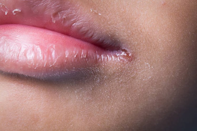 B2 Vitamini Eksikliğinde Görülen Hastalıklar Nelerdir?