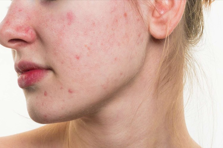 B5 Vitamini Eksikliği Sivilce Yapar Mı?