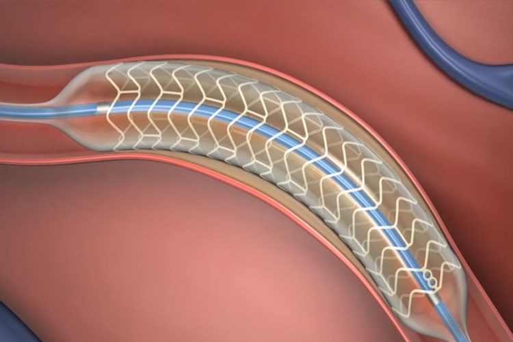 Bacağa Stent Takıldıktan Sonra Ağır Yük Kaldırılır Mı?