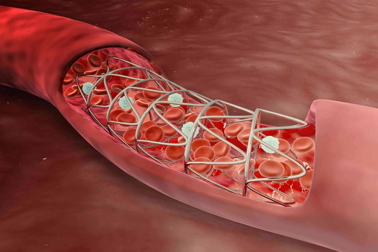 Bacağa Stent Takıldıktan Sonra Ağrı Olur Mu?