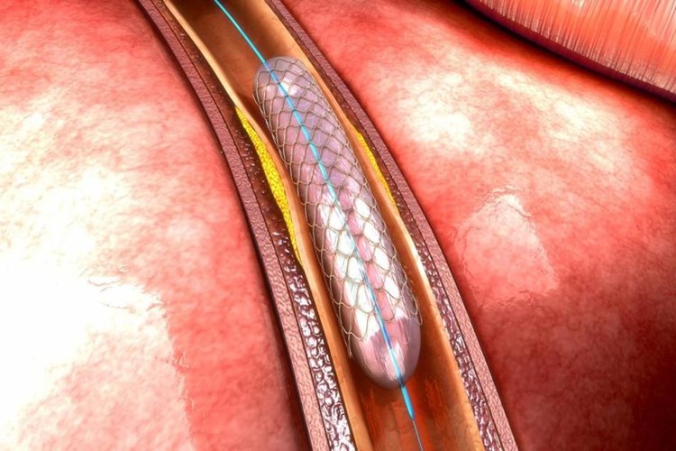Bacağa Stent Takıldıktan Sonra Çarpıntı Nasıl Geçer?