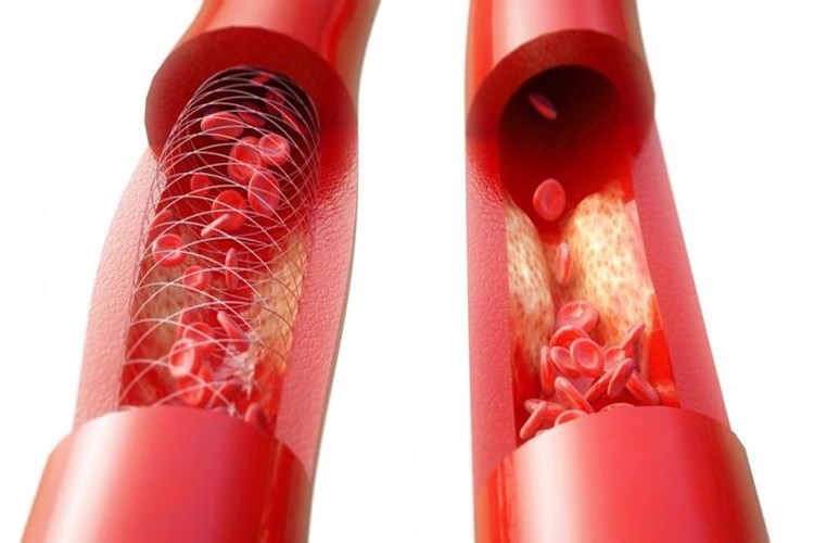 Bacağa Stent Takıldıktan Sonra Çarpıntı Neden Olur?