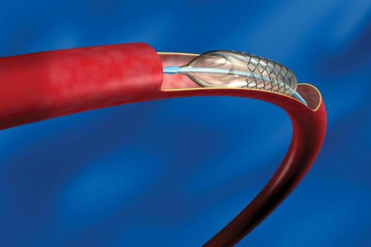 Bacağa Stent Takıldıktan Sonra Çarpıntı Olur Mu?