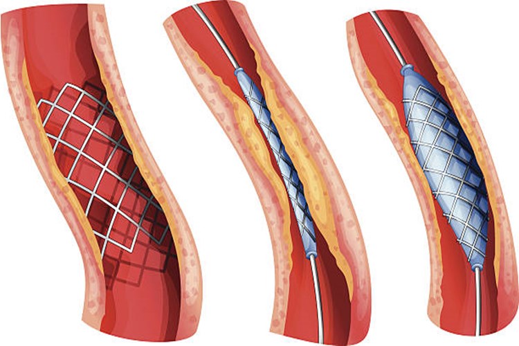 Bacağa Stent Takıldıktan Sonra Tıkanma Nasıl Geçer?