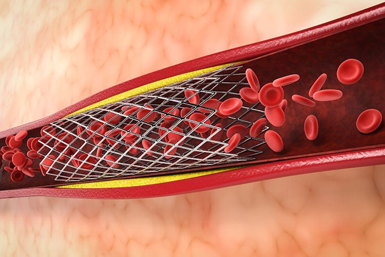 Bacağa Stent Takıldıktan Sonra Tıkanma Neden Olur?