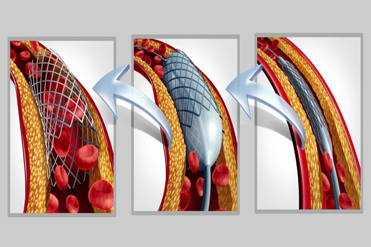 Bacağa Stent Takıldıktan Sonra Uçak Yolculuğu Yapılır Mı?
