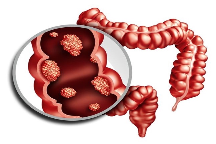 Bağırsak Polipleri Neden Olur?