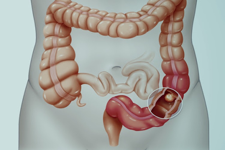 Bağırsak Tıkanıklığı Belirtileri Nelerdir?