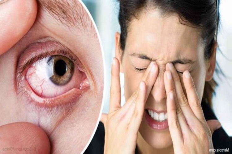 Bahar Alerjisi Sebebiyle Göz Kaşıntısı Sebepleri Nelerdir?