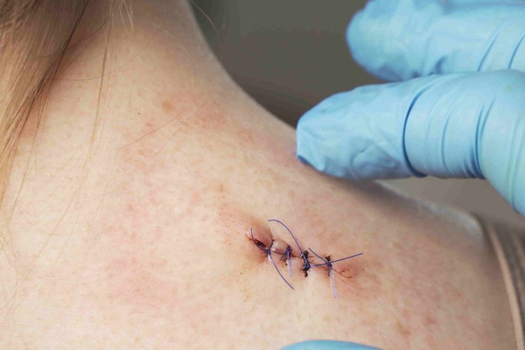 Batikon Dikişlere İyi Gelir Mi?